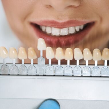 Veneers