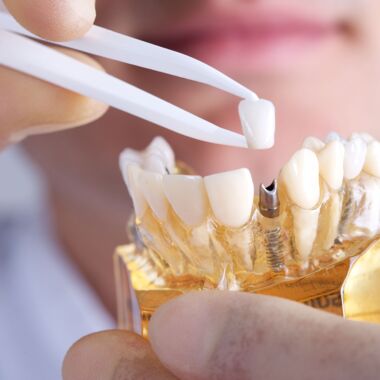 Implantate